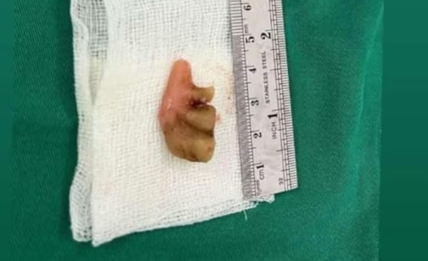 No era neumonía, tenía una prótesis dental en el pulmón - Noticiero Paraguay