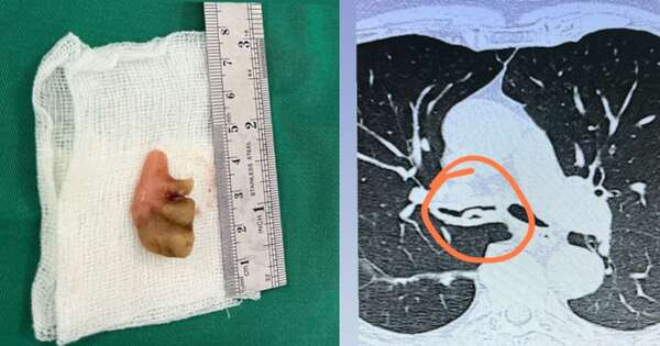 Diario HOY | Extraen prótesis dental del bronquio de un anciano: estaba allí desde hace 27 años