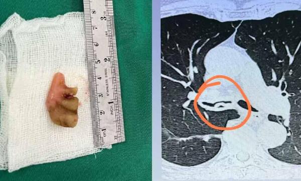 Extraen prótesis dental del bronquio de un anciano: estaba allí desde hace 27 años – Prensa 5