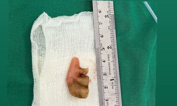 ¡Bien ahí! sacaron la prótesis que tragó un abuelito hace 27 años