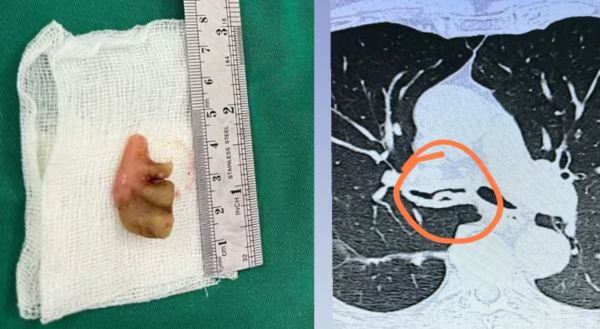 Extraen prótesis dental que estaba hace 27 años en el bronquio de un anciano - Unicanal