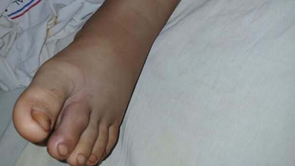 Niño fue mordido por una yarará y necesita ayuda