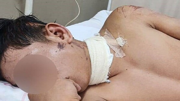 Motociclista por poco no fue decapitado por un alambre colocado en plena calle