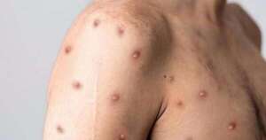La Nación / Sigue alerta máxima por epidemia de mpox