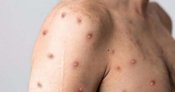 La Nación / Sigue alerta máxima por epidemia de mpox