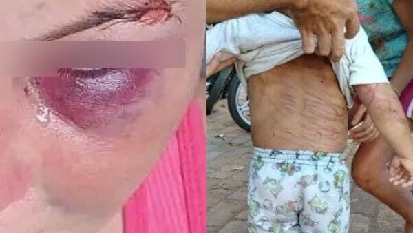 Cruel padrastro marcó la espaldita de un nenito y golpeó a su pareja