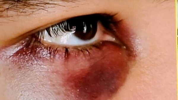 Un colegiante le dejó así su ojo al compañero “por celos”