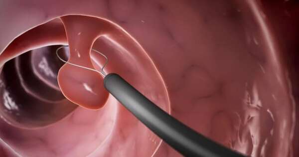 Diario HOY | Pólipos rectales: cómo evitarlos, cuáles son los más peligrosos y cuándo llegan a cáncer