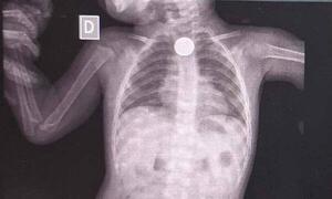Médicos extrajeron con éxito una moneda tragada por un niño de 1 año en Coronel Oviedo – Prensa 5