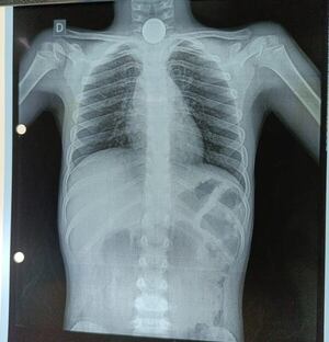 Procedimiento médico para la foto: así se encuentra el niño que tragó una moneda - Nacionales - ABC Color