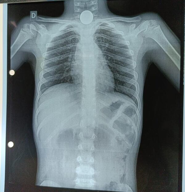 Procedimiento médico para la foto: así se encuentra el niño que tragó una moneda - Nacionales - ABC Color