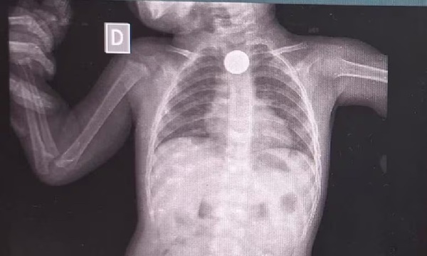 Denuncian que rechazaron a un niño en el Hospital General de Coronel Oviedo - OviedoPress