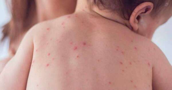 La Nación / Aumentan casos de sarampión en Argentina; en Paraguay instan a la vacunación para evitar brotes