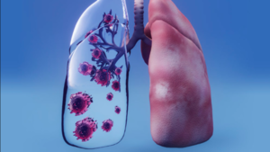 Tuberculosis en Paraguay: Mayor número de casos se dan en cárceles y poblaciones indígenas