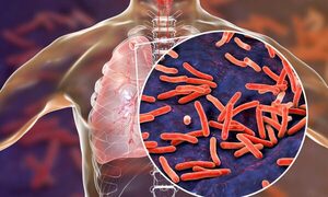 Hoy se recuerda el Día Mundial de la Tuberculosis