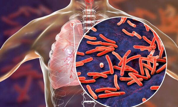 Hoy se recuerda el Día Mundial de la Tuberculosis