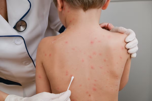 Desde Salud instan a la vacunación contra el sarampión para evitar brotes - trece
