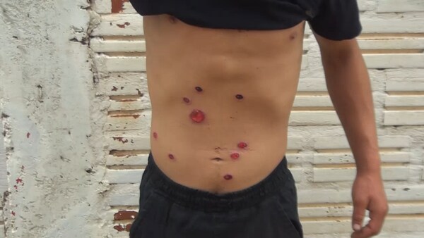 Joven herido con balines de goma tras discusión en estacionamiento de local comercial en Encarnación