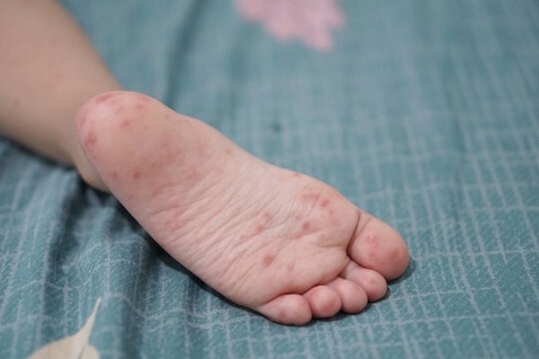 Síntomas del Coxsackievirus: fiebre, llagas y sarpullido - Portal Digital Cáritas Universidad Católica