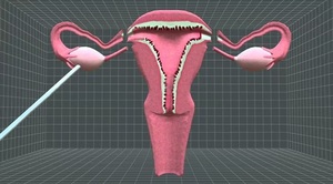 Nace por primera vez un bebé en Reino Unido tras un trasplante de útero