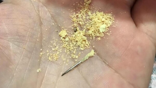 Niño de 7 años casi traga una aguja en chipita de la escuela