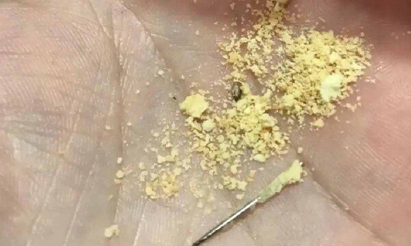 Hambre Cero: Padre denuncia hallazgo de una aguja en chipita de la merienda escolar – Prensa 5