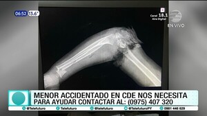 Grave accidente doméstico: Bebé de 2 años herido por centrifugadora en CDE