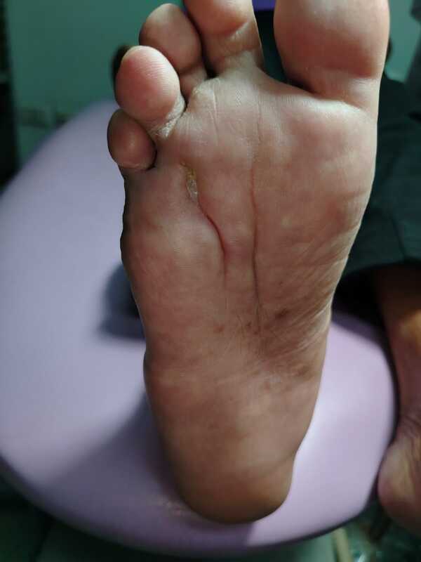 Alta médica para paciente tratada con Terapia Larval - 1000 Noticias