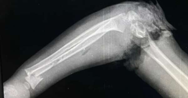 Diario HOY | Niño resultó herido tras meter su brazo en centrifugadora