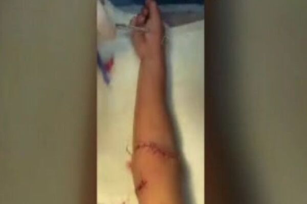 Niño casi pierde el brazo al meterlo en una centrifugadora en Presidente Franco - SNT