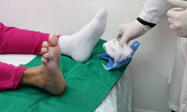 Salvan pie diabético tras tratamiento con larvas – Prensa 5
