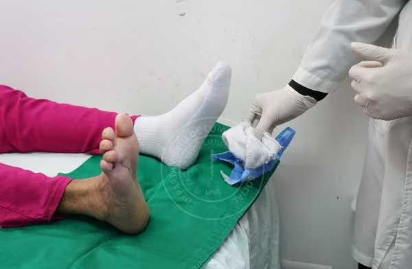 Tratamiento con larvas de mosca evita mutilación del pie de paciente diabética - Noticiero Paraguay