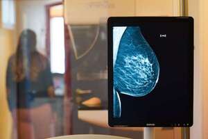Cáncer de mama: ¿en qué puestos de salud pública puedo acceder a mamografías? - Nacionales - ABC Color