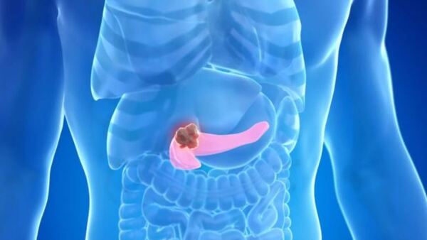Investigadores identifican una de las claves de la agresividad del cáncer de páncreas