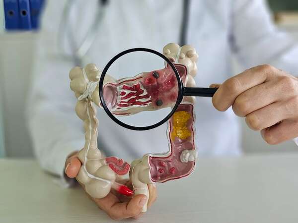 Eficacia de la inmunoterapia con células DOT contra el cáncer colorrectal es demostrada - Ciencia - ABC Color