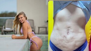 Laisa vivió un infierno tras lipo: “La cirugía de mis sueños se convirtió en pesadilla”