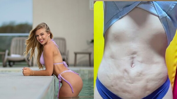 Laisa vivió un infierno tras lipo: “La cirugía de mis sueños se convirtió en pesadilla”