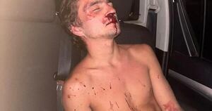 Diario HOY | Conductor de plataforma sufrió brutal golpiza y corre riesgo de perder un ojo