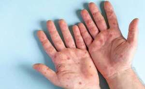 Mpox: continúa la vigilancia activa en el país por circulación de viruela símica - Nacionales - ABC Color