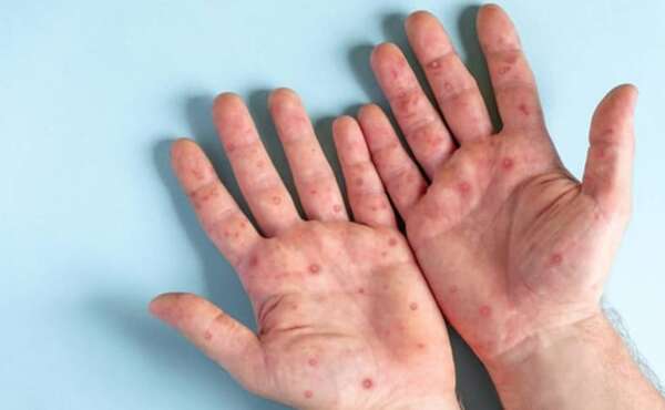 Mpox: continúa la vigilancia activa en el país por circulación de viruela símica - Nacionales - ABC Color