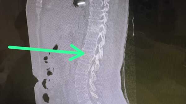 Chofer de micro atropelló lomada y pasajera se fisuró la columna