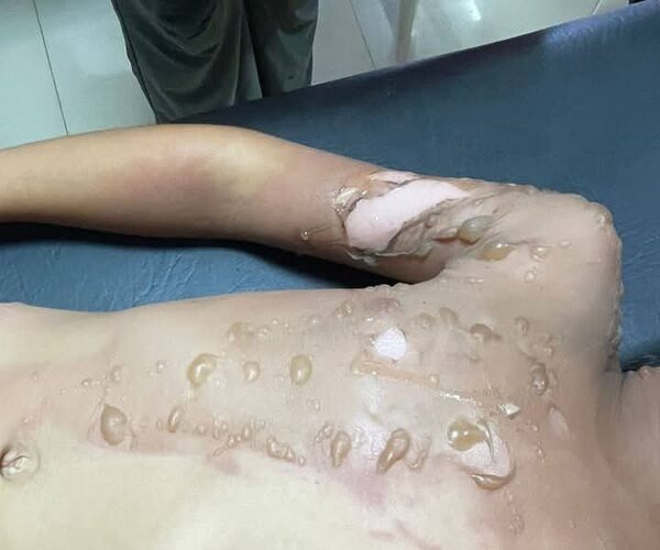 Infeliz tiró comida caliente a su hija de 6 años