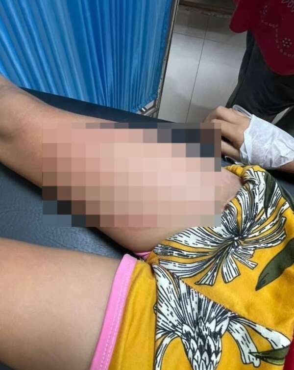 Tobatí: padrastro tira comida caliente y quema a hijastra de 6 años - Nacionales - ABC Color