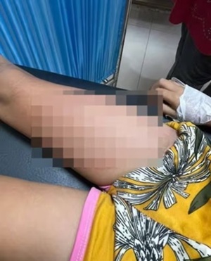 Detenido e imputado un hombre que arrojó comida caliente a una niña de 6 años en Tobatí