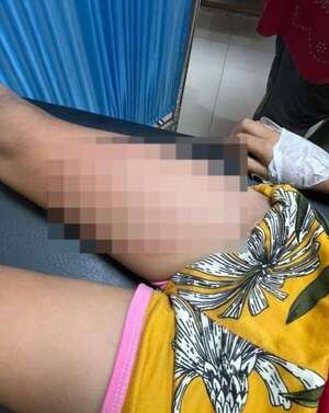 Niña quemada con comida caliente tiene daños en el 16% del cuerpo  - Policiales - ABC Color