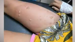 Nena quemada por su padrastro con comida caliente quedó con el 16% del cuerpo afectado