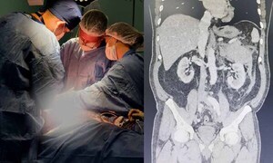 Paciente de 58 años fue sometido a una compleja cirugía en el Hospital General de Coronel Oviedo – Prensa 5