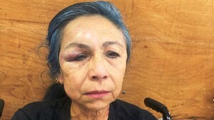 Enfermera sufre robo y brutal golpiza por parte de una pareja de adictos en Luque