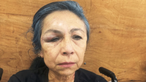 Enfermera es brutalmente golpeada durante asalto en Luque