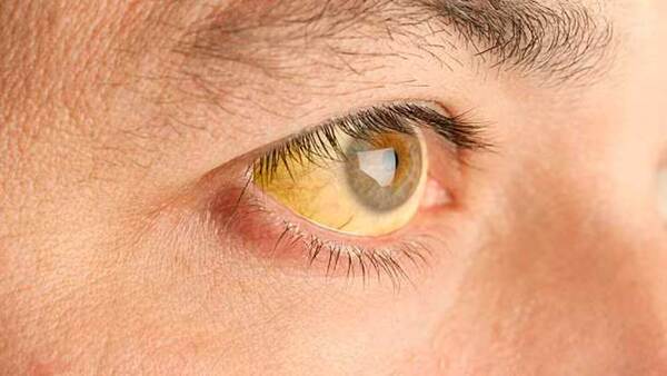 Alertan sobre alto riesgo de brotes de fiebre amarilla en las Américas: 235 casos confirmados